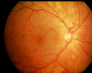 Fons d'ull en retinopatia diabètica proliferativa